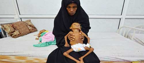 کودکان یمن همچنان قربانی وبای سعودی