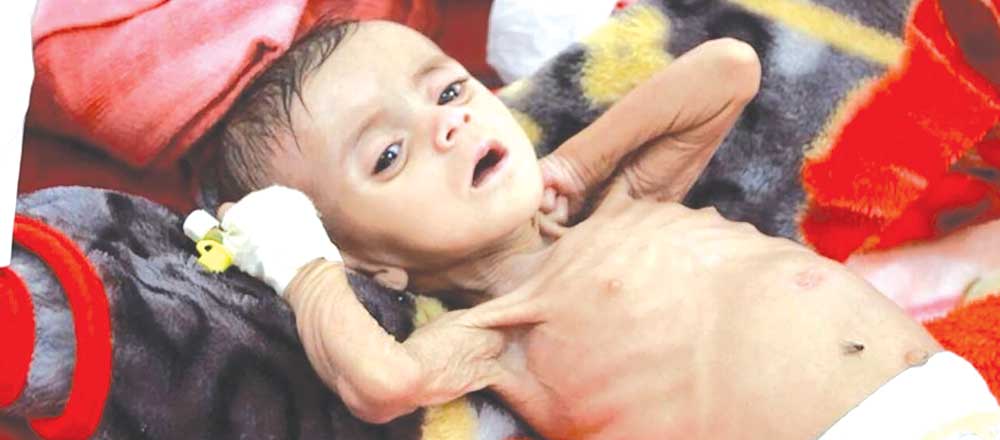هر دو ساعت یک مادر و شش نوزاد یمنی جان می‌دهند